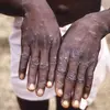 Κρούσμα mpox στο Κονγκό